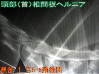 頸部（首）椎間板ヘルニア
