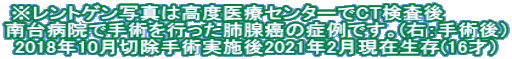 ※レントゲン写真は高度医療センターでCT検査後　　　　 南台病院で手術を行った肺腺癌の症例です。(右：手術後） 2018年10月切除手術実施後2021年2月現在生存(16才） 